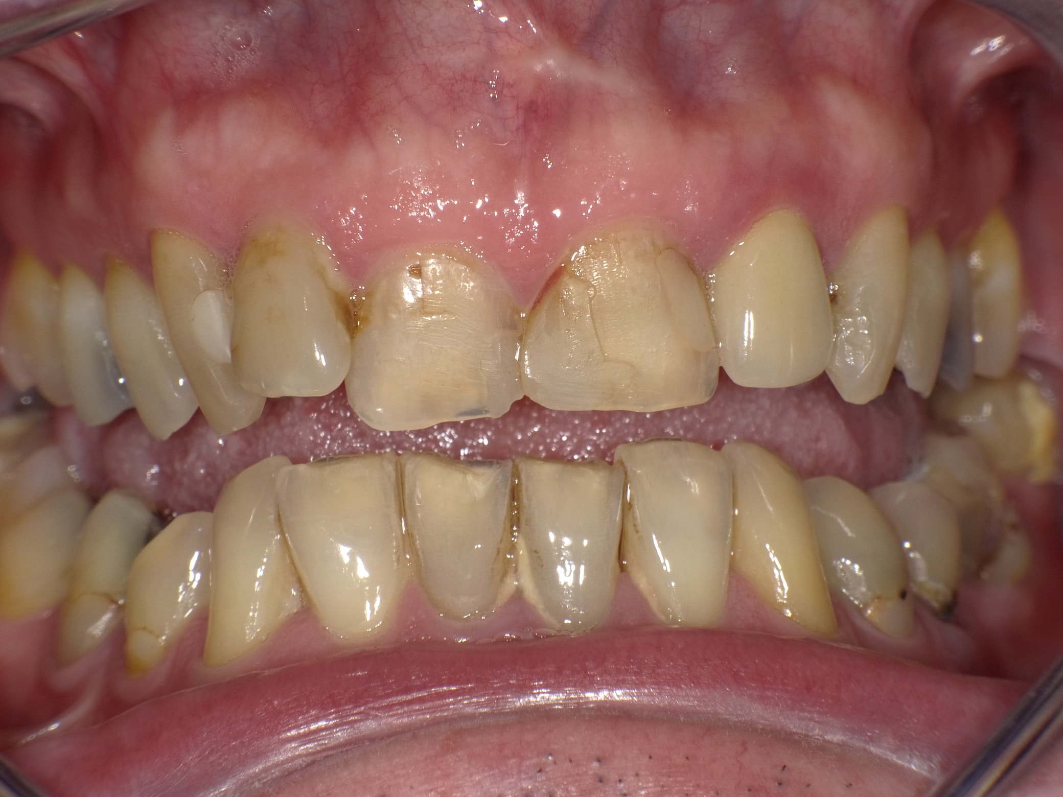 Sehr unzufriedener Patient, der immer wieder Reparaturen mit Kunststoff und einzelnen Kronen bei seinem langjährigen Zahnarzt bekommen hat